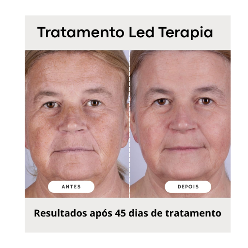 ✨ Mascarilla Facial LED de Silicona Photon High – Reducción de Manchas, Líneas Finas y Acción Antiacné